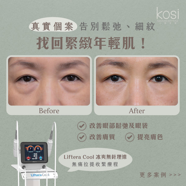 Liftera Cool 冰爽無針埋線療程 (面+眼周+雙下巴)
