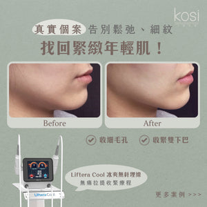 Liftera Cool 冰爽無針埋線療程 (面+眼周+雙下巴)