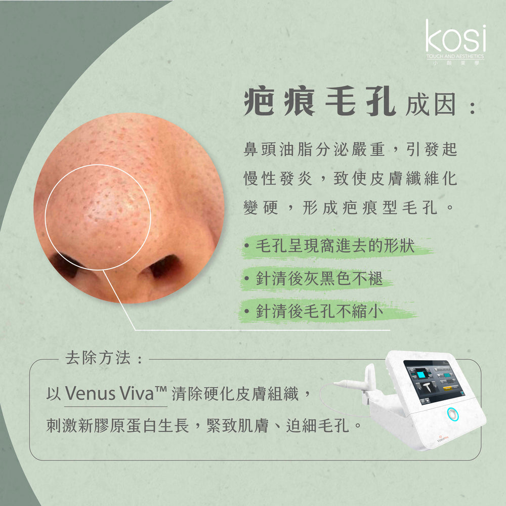 Venus Viva™ 再生換膚儀 - 鼻頭去黑頭/收毛孔療程(鼻)