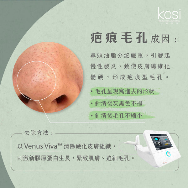 Venus Viva™ 再生換膚儀 - 鼻頭去黑頭/收毛孔療程(鼻)