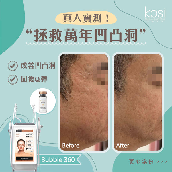 Bubble 360 無痛收毛孔及凹凸洞療程