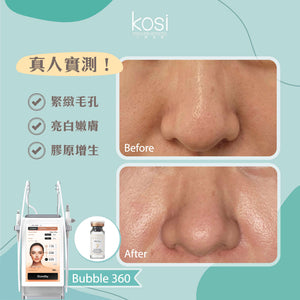 Bubble 360 無痛收毛孔及凹凸洞療程