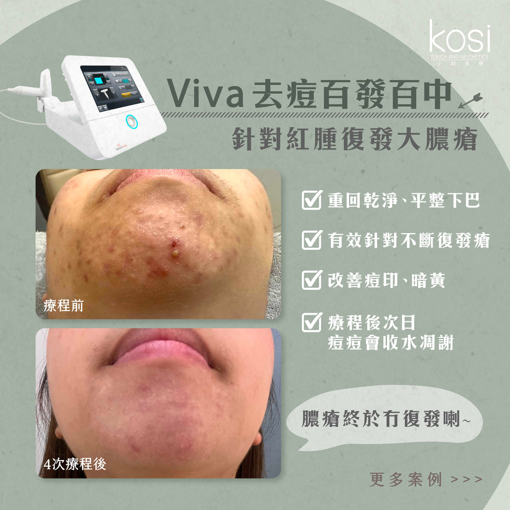 Venus Viva™ 再生換膚儀 - 淨痘/收毛孔去瑕療程(全面)