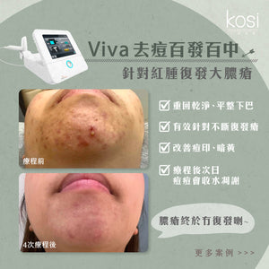 Venus Viva™ 再生換膚儀 - 淨痘/收毛孔去瑕療程(全面)