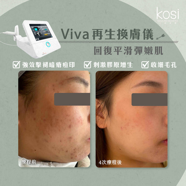 Venus Viva™ 再生換膚儀 - 淨痘/收毛孔去瑕療程(全面)