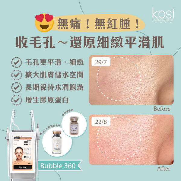 Bubble 360 無痛收毛孔及凹凸洞療程
