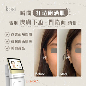 Linear Z線狀電波 - LIFU提升去皺療程(面+雙下巴)