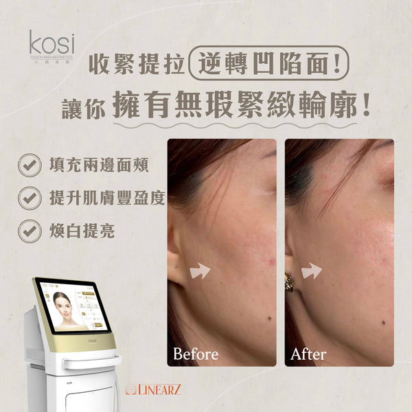 Linear Z線狀電波 - LIFU提升去皺療程(面+雙下巴)