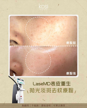 LaseMD表皮重生 - 拋光淡斑去紋療程(面部)