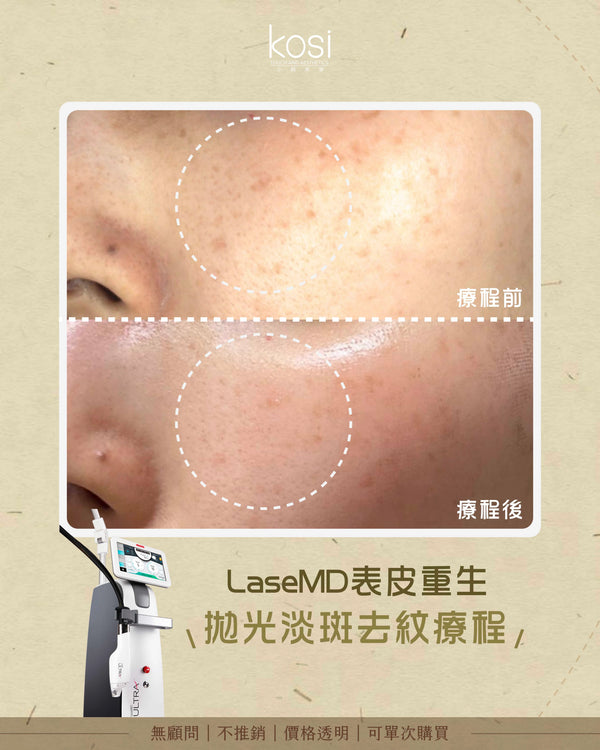 LaseMD表皮重生 - 拋光淡斑去紋療程(面部)