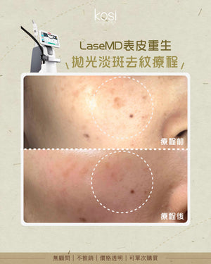 LaseMD表皮重生 - 拋光淡斑去紋療程(面部)