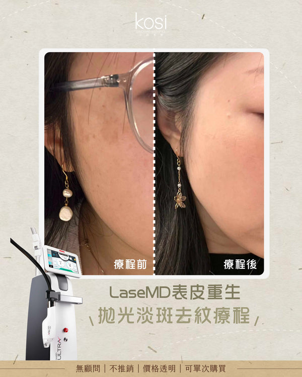 LaseMD表皮重生 - 拋光淡斑去紋療程(面部)