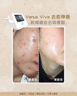 Venus Viva™ 再生換膚儀 - 淨痘/收毛孔去瑕療程(全面)