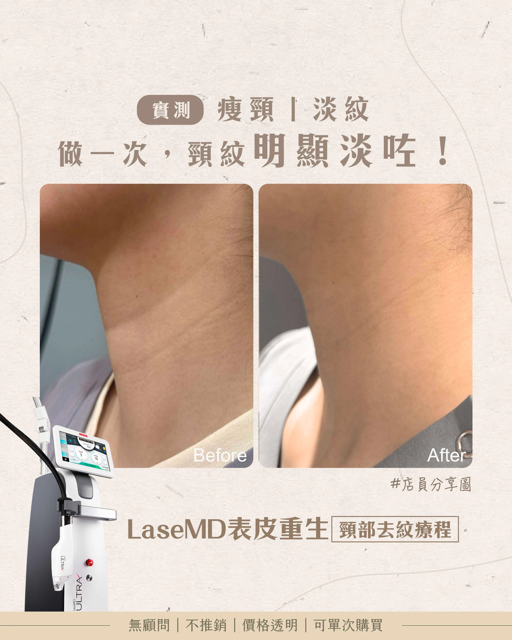 LaseMD表皮重生 - 頸部去紋收緊療程(頸)