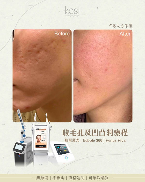 Bubble 360 無痛收毛孔及凹凸洞療程