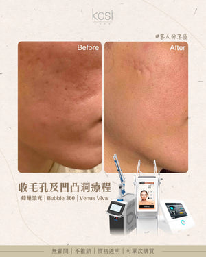 Bubble 360 無痛收毛孔及凹凸洞療程