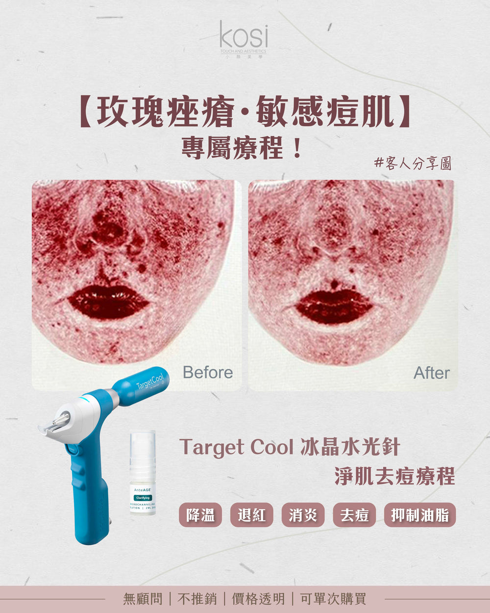 Target Cool 冰晶水光針 - 淨肌去痘療程