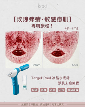 Target Cool 冰晶水光針 - 淨肌去痘療程