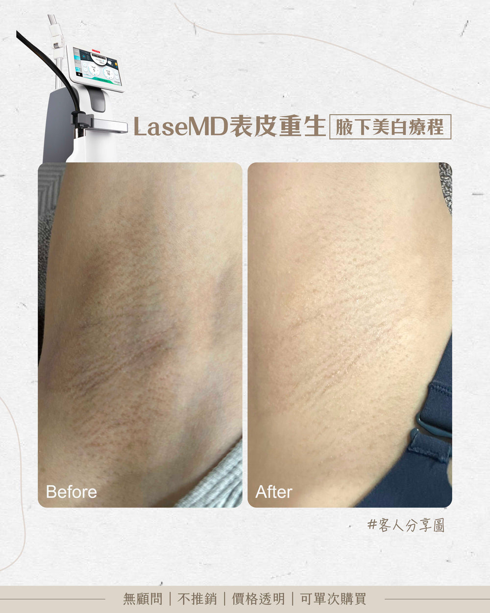 LaseMD表皮重生 -  腋下極緻美白嫩膚療程