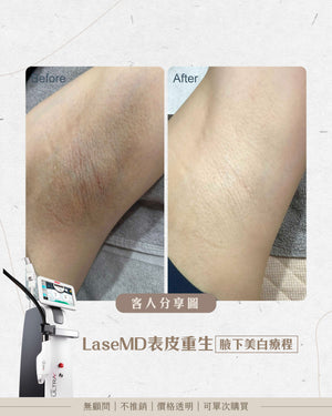 LaseMD表皮重生 -  腋下極緻美白嫩膚療程