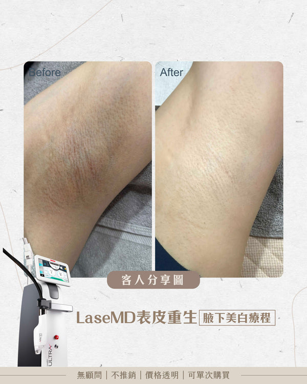 LaseMD表皮重生 -  腋下極緻美白嫩膚療程