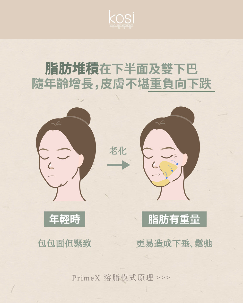 Alma PrimeX 超頻緊膚儀 - weewee聲超聲波雙下巴溶脂療程