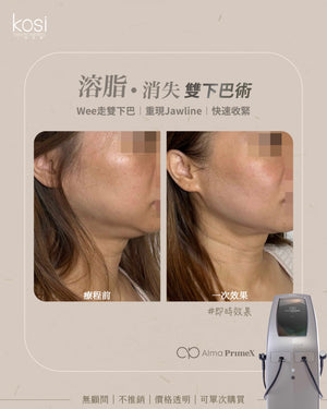 Alma PrimeX 超頻緊膚儀 - weewee聲超聲波雙下巴溶脂療程