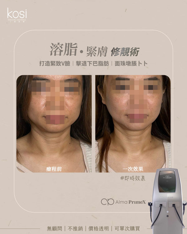Alma PrimeX 超頻緊膚儀 - weewee聲超聲波雙下巴溶脂療程
