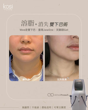 Alma PrimeX 超頻緊膚儀 - weewee聲超聲波雙下巴溶脂療程