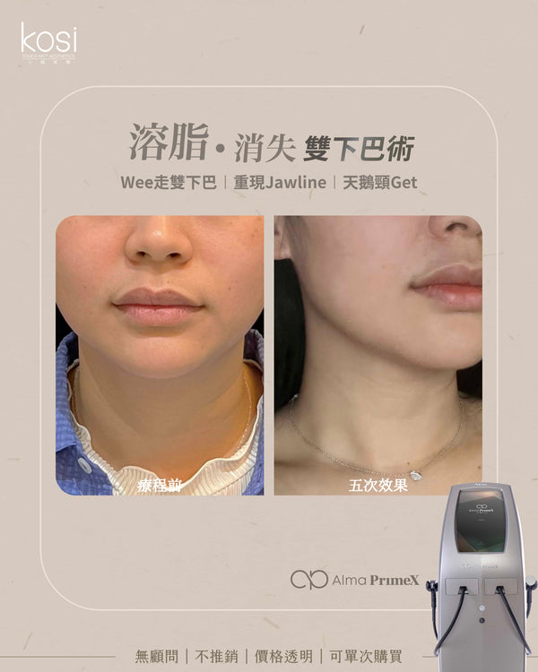 Alma PrimeX 超頻緊膚儀 - weewee聲超聲波雙下巴溶脂療程