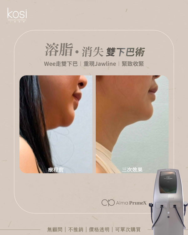 Alma PrimeX 超頻緊膚儀 - weewee聲超聲波雙下巴溶脂療程