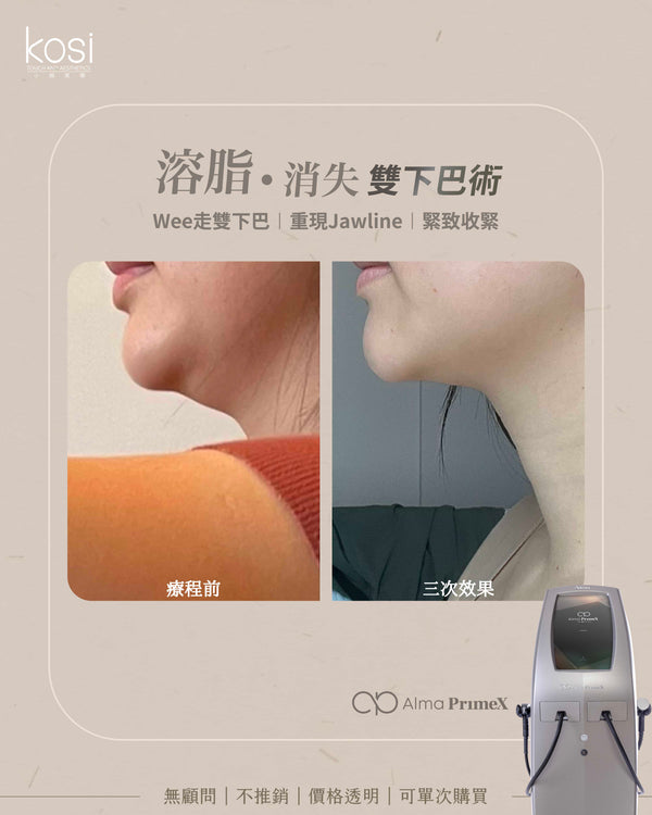 Alma PrimeX 超頻緊膚儀 - weewee聲超聲波雙下巴溶脂療程