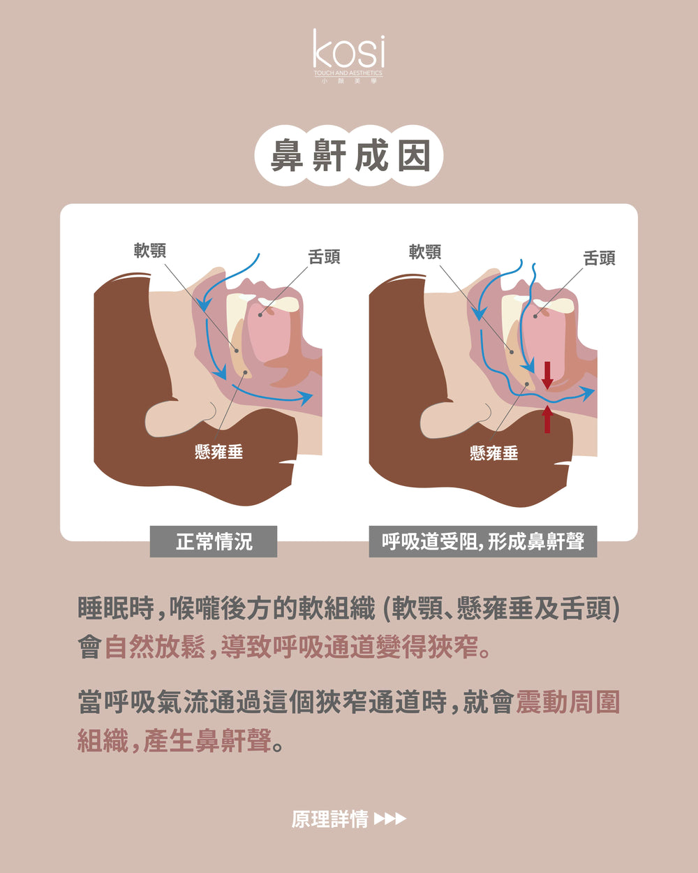 Fotona NightLase 無創去鼻鼾療程