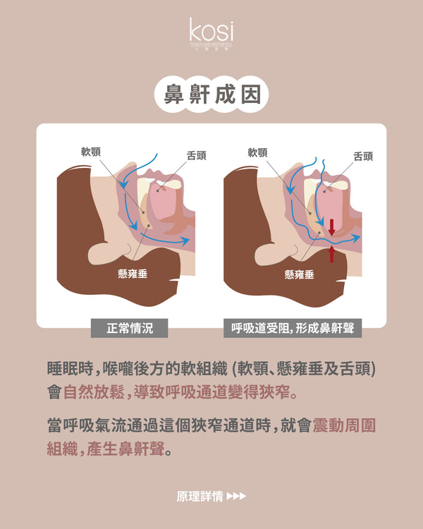 Fotona NightLase 無創去鼻鼾療程
