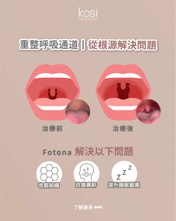 Fotona NightLase 無創去鼻鼾療程