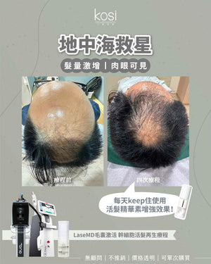 LaseMD表皮重生 -  幹細胞活髮再生療程(局部/半頭)