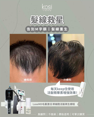 LaseMD表皮重生 -  幹細胞活髮再生療程(局部/半頭)