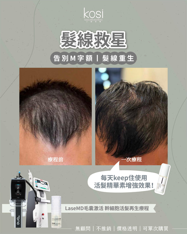 LaseMD表皮重生 -  幹細胞活髮再生療程(局部/半頭)