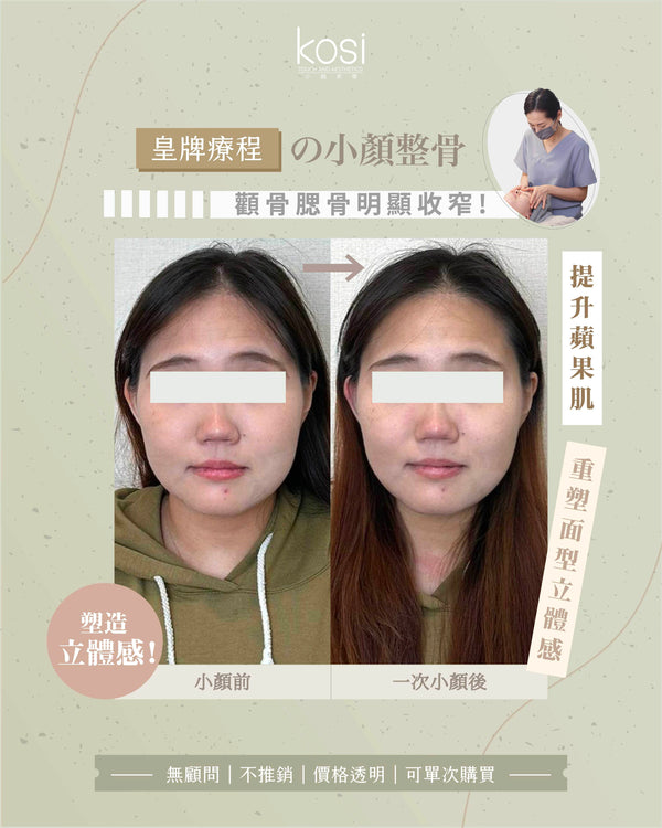 Kosi皇牌小顏整骨療程