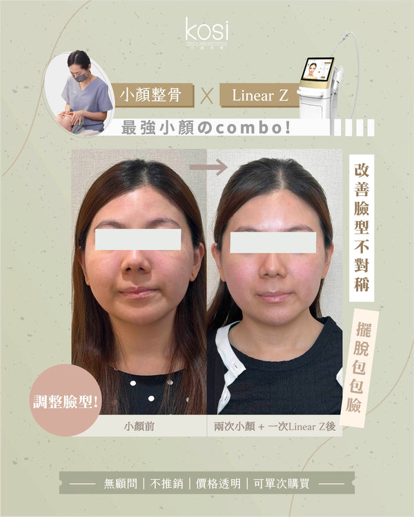 Kosi皇牌小顏整骨療程
