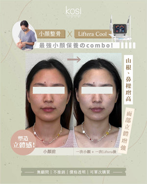 Kosi皇牌小顏整骨療程