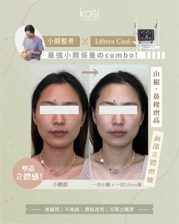 Kosi皇牌小顏整骨療程