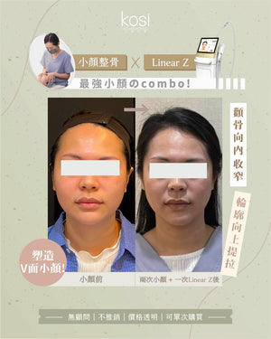 Kosi皇牌小顏整骨療程