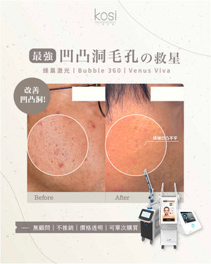 Bubble 360 無痛收毛孔及凹凸洞療程