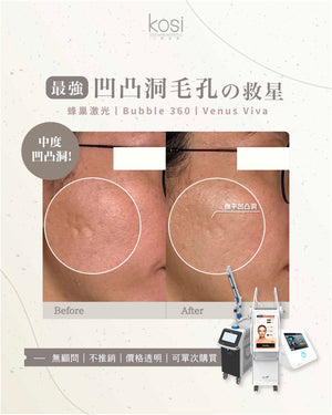 Bubble 360 無痛收毛孔及凹凸洞療程