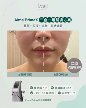 Alma PrimeX 超頻緊膚儀 - 煙花射頻泵泵漲療程(面部+眼周)