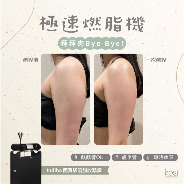 Indiba 國寶級溶脂收緊儀 - 內外夾擊減脂療程