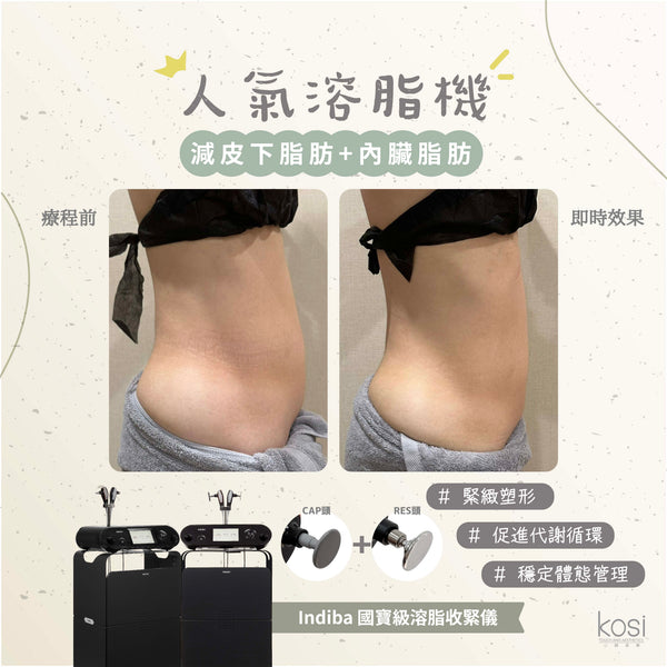 Indiba 國寶級溶脂收緊儀 - 內外夾擊減脂療程