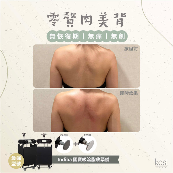 Indiba 國寶級溶脂收緊儀 - 內外夾擊減脂療程