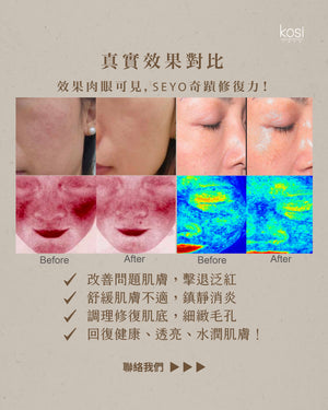 SEYO 無創注氧水光儀 - Proderm 抗敏修復療程(面部及頸部)